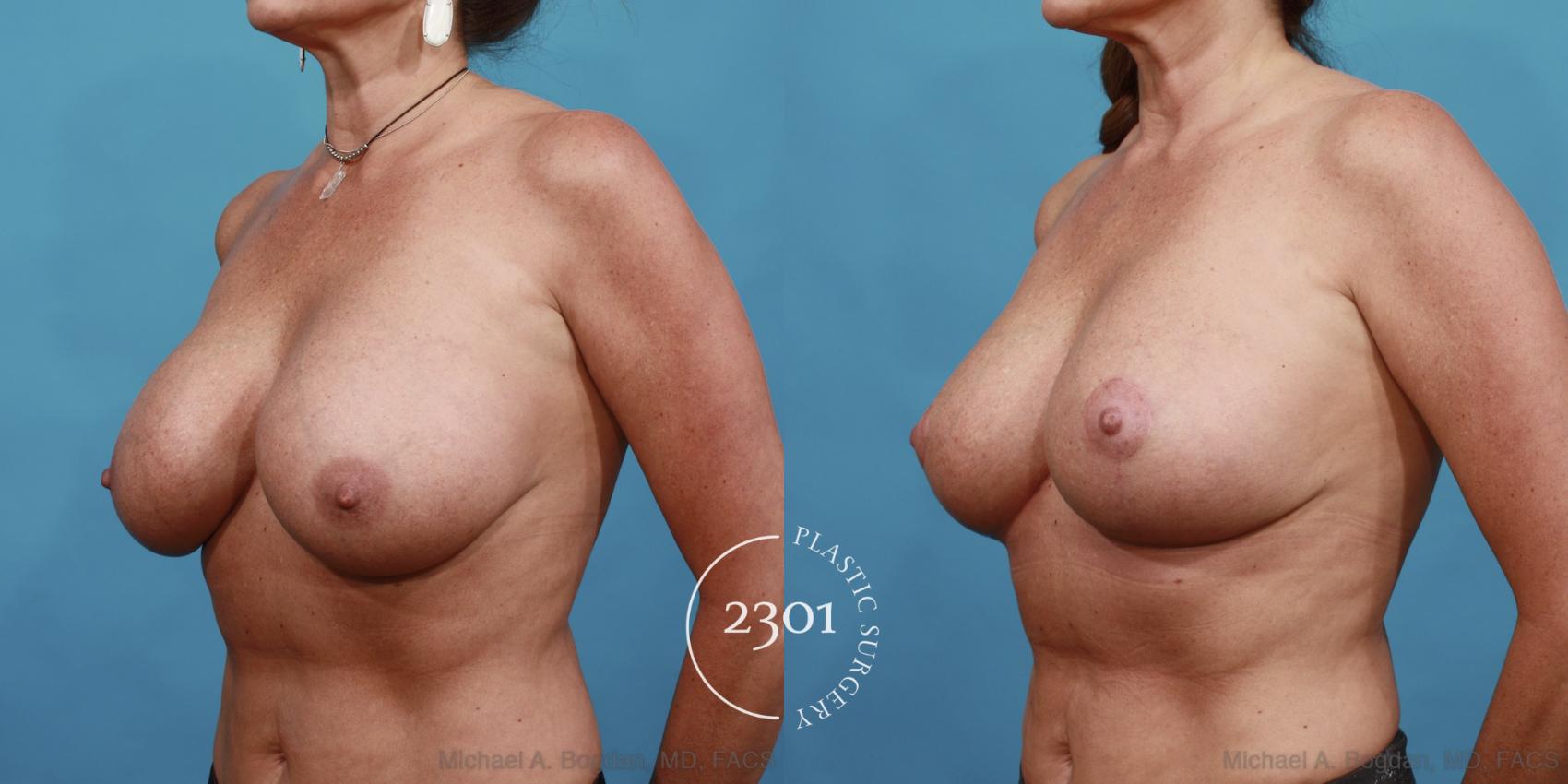 Before & After Breast Augmentation Revision Case 501 View #2 View in Fort Worth, Plano, & Frisco, Texas