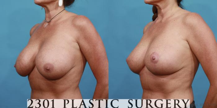 Before & After Breast Augmentation Revision Case 501 View #2 View in Fort Worth, Plano, & Frisco, Texas