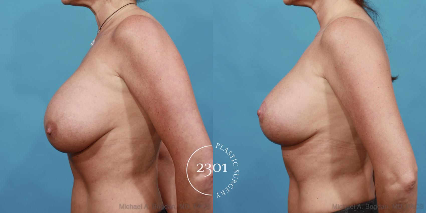Before & After Breast Augmentation Revision Case 501 View #3 View in Fort Worth, Plano, & Frisco, Texas