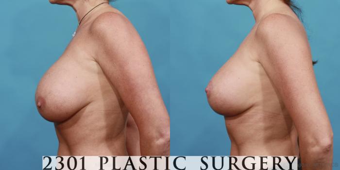 Before & After Breast Augmentation Revision Case 501 View #3 View in Fort Worth, Plano, & Frisco, Texas