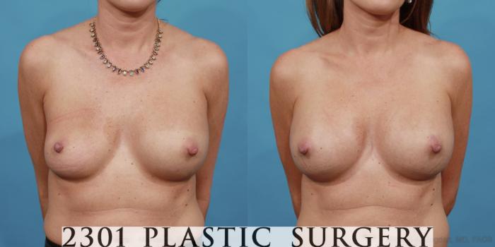 Before & After Breast Augmentation Revision Case 514 View #1 View in Fort Worth, Plano, & Frisco, Texas