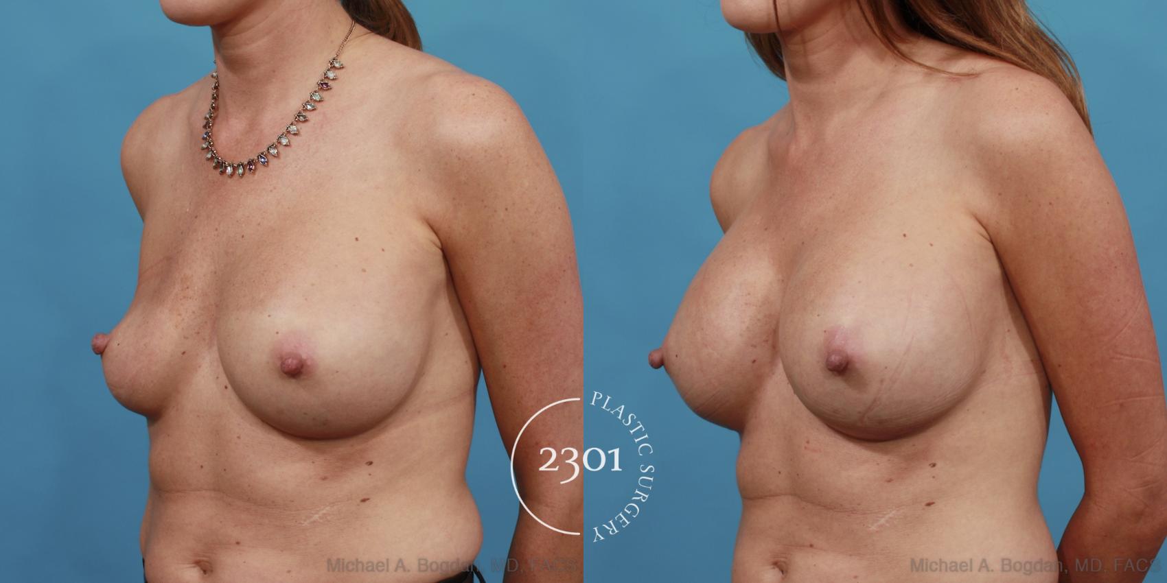 Before & After Breast Augmentation Revision Case 514 View #2 View in Fort Worth, Plano, & Frisco, Texas