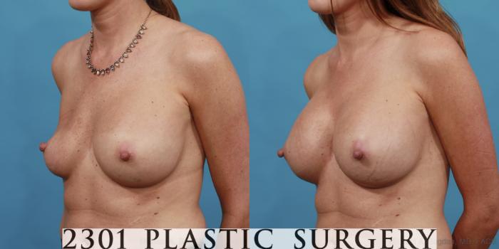 Before & After Breast Augmentation Revision Case 514 View #2 View in Fort Worth, Plano, & Frisco, Texas