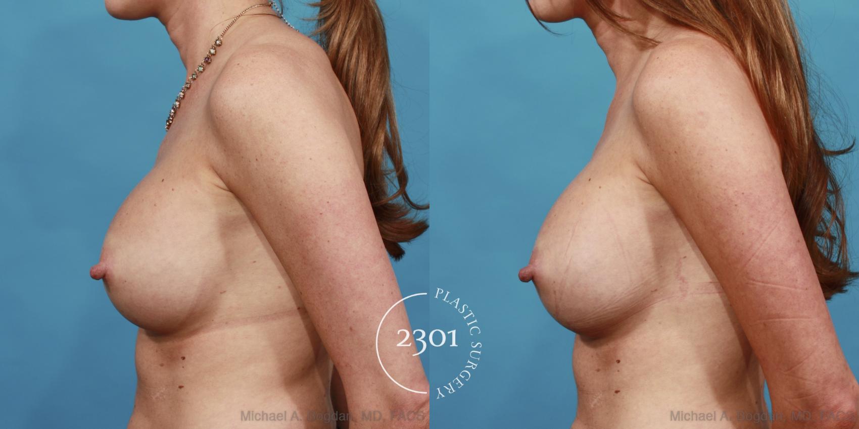 Before & After Breast Augmentation Revision Case 514 View #3 View in Fort Worth, Plano, & Frisco, Texas