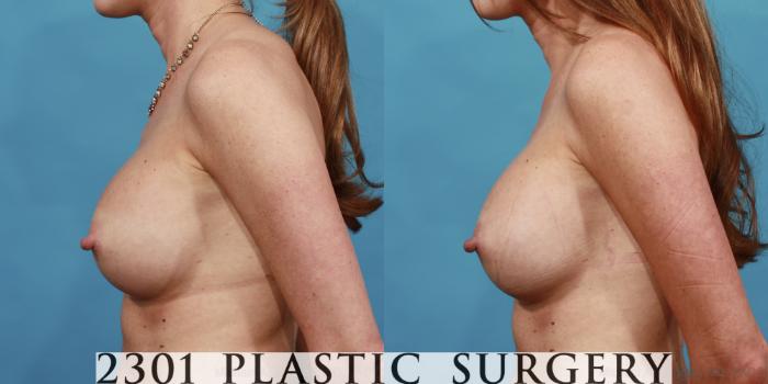 Before & After Breast Augmentation Revision Case 514 View #3 View in Fort Worth, Plano, & Frisco, Texas