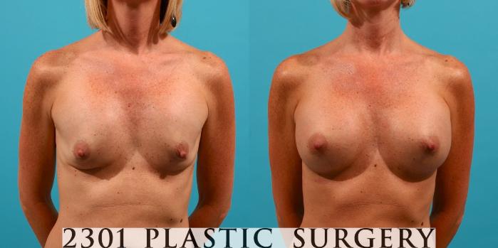 Before & After Silicone Implants Case 54 View #1 View in Fort Worth, Plano, & Frisco, Texas