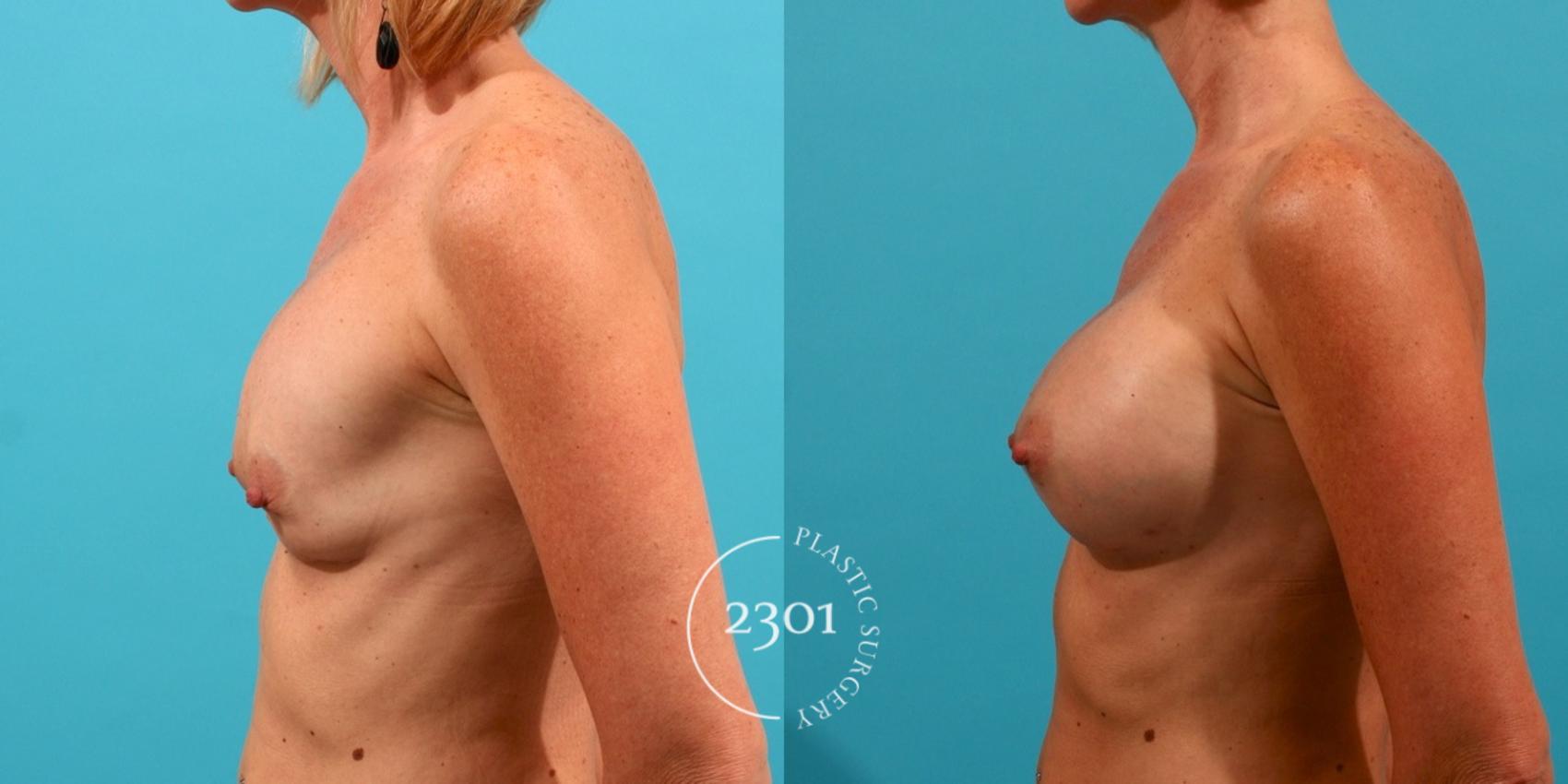 Before & After Silicone Implants Case 54 View #2 View in Fort Worth, Plano, & Frisco, Texas