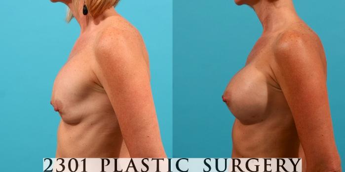 Before & After Silicone Implants Case 54 View #2 View in Fort Worth, Plano, & Frisco, Texas