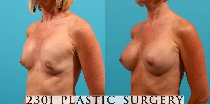 Before & After Breast Augmentation Revision Case 54 View #3 View in Fort Worth, Plano, & Frisco, Texas