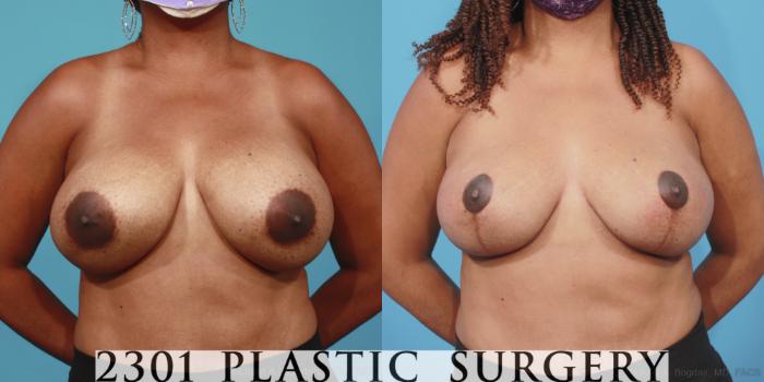 Before & After Breast Augmentation Revision Case 656 Front View in Fort Worth, Plano, & Frisco, Texas