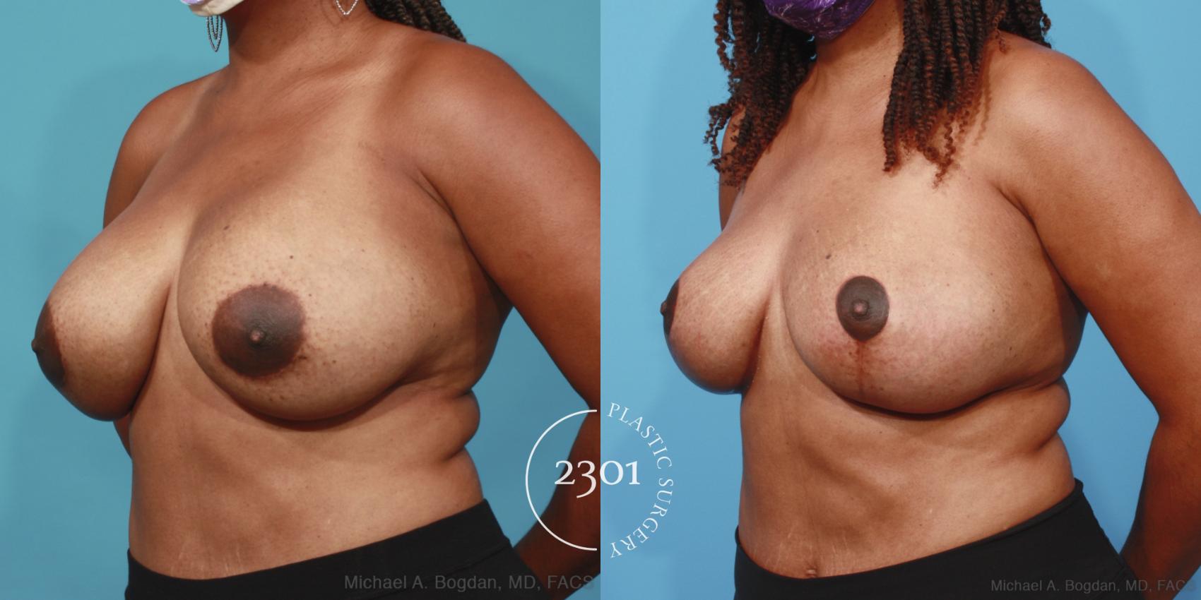 Before & After Breast Augmentation Revision Case 656 Left Oblique View in Fort Worth, Plano, & Frisco, Texas