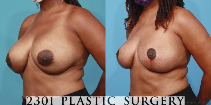 Before & After Breast Augmentation Revision Case 656 Left Oblique View in Fort Worth, Plano, & Frisco, Texas