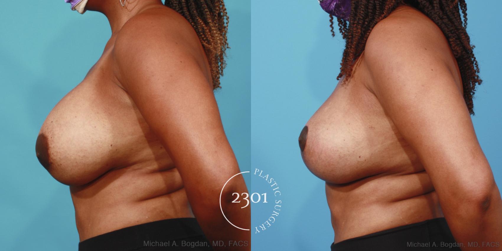 Before & After Breast Augmentation Revision Case 656 Left Side View in Fort Worth, Plano, & Frisco, Texas