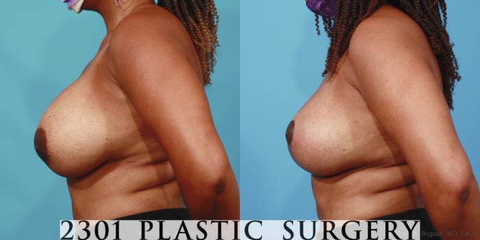 Before & After Breast Augmentation Revision Case 656 Left Side View in Fort Worth, Plano, & Frisco, Texas