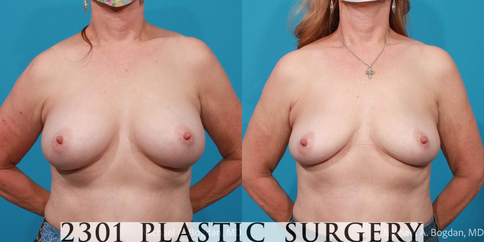 Before & After Breast Augmentation Revision Case 700 Front View in Fort Worth, Plano, & Frisco, Texas