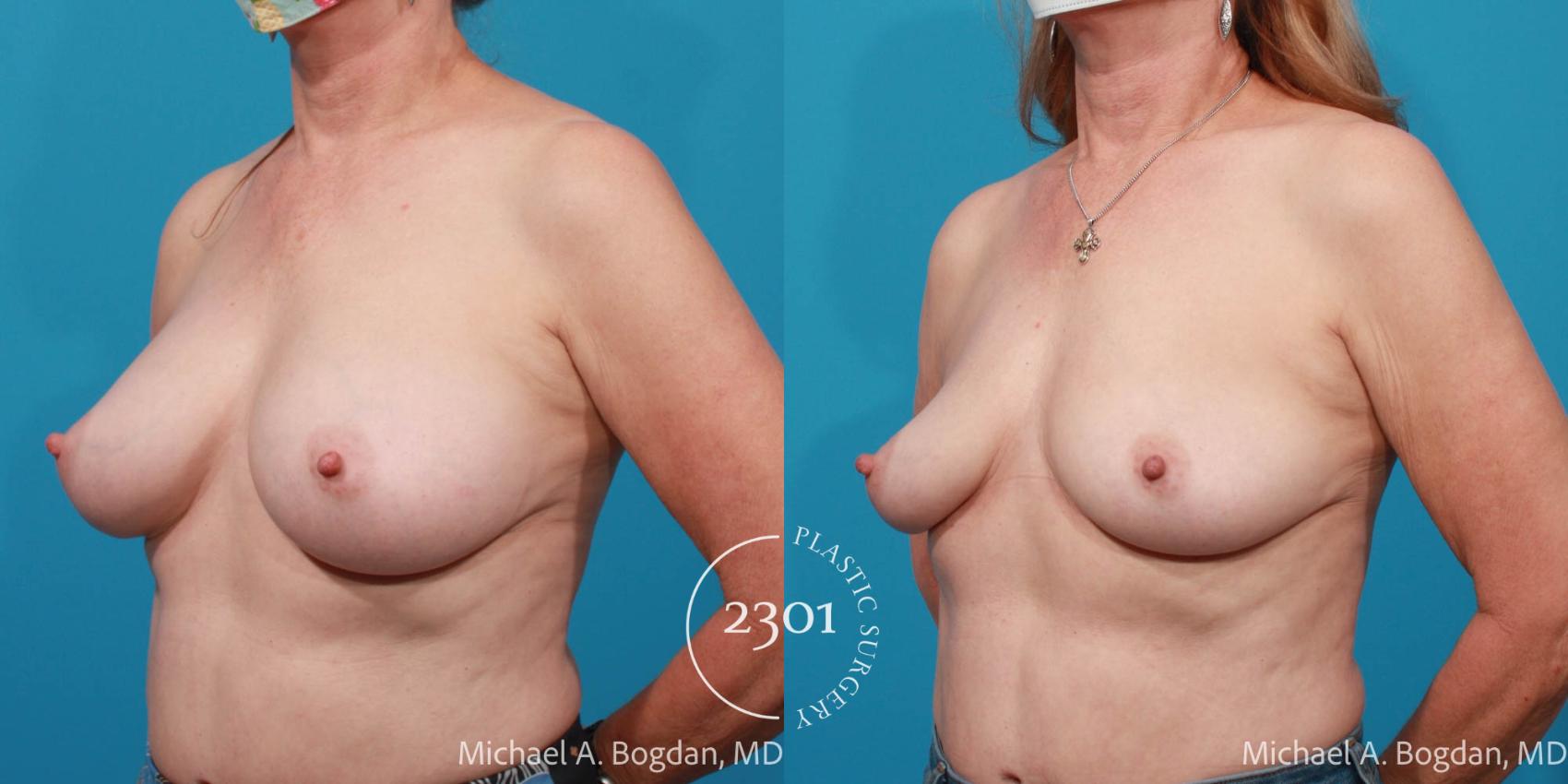 Before & After Breast Augmentation Revision Case 700 Left Oblique View in Fort Worth, Plano, & Frisco, Texas