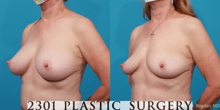 Before & After Breast Augmentation Revision Case 700 Left Oblique View in Fort Worth, Plano, & Frisco, Texas