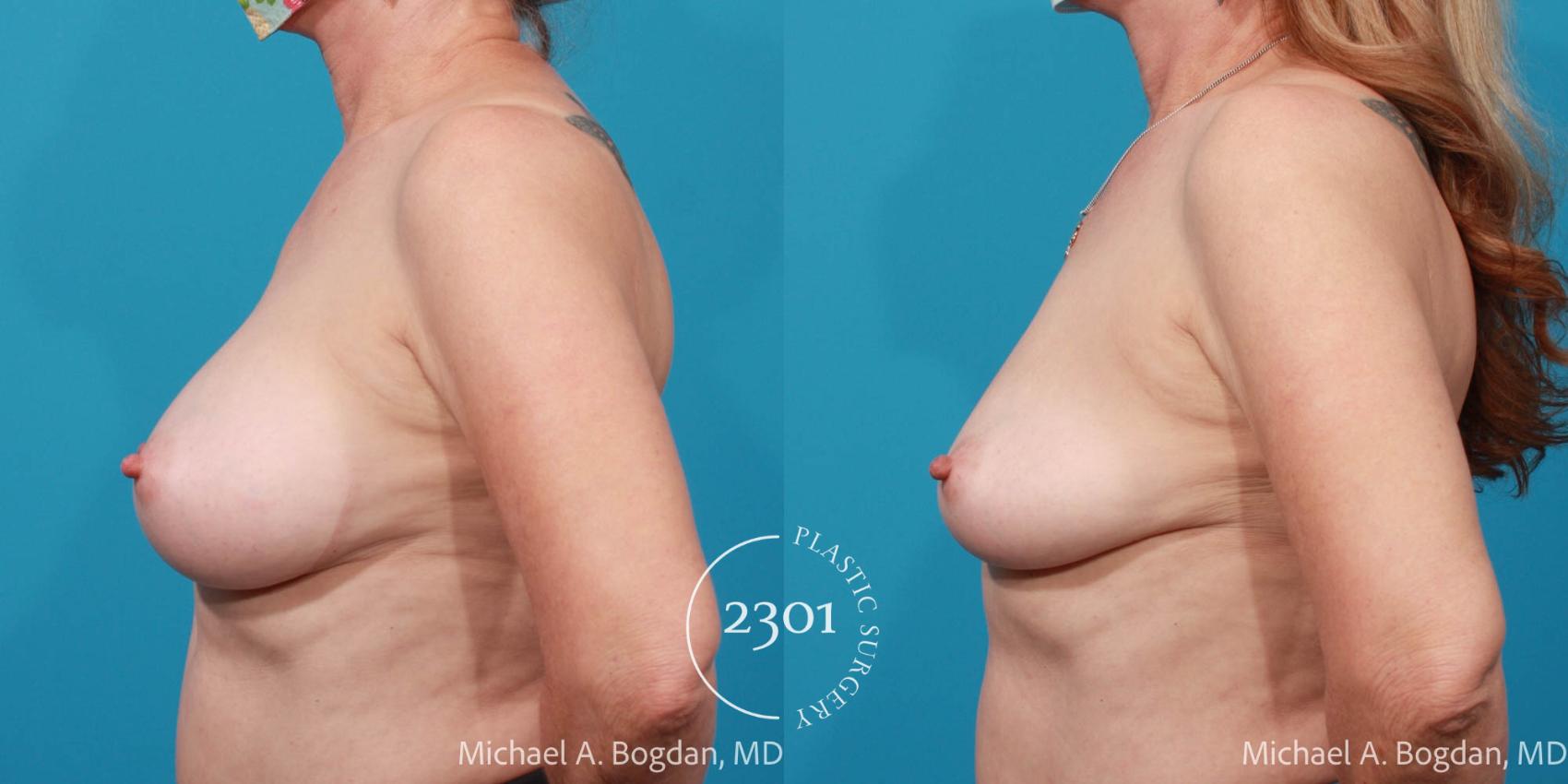 Before & After Breast Augmentation Revision Case 700 Left Side View in Fort Worth, Plano, & Frisco, Texas