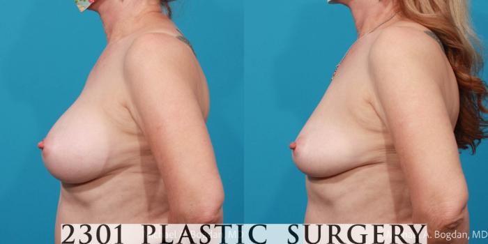 Before & After Breast Augmentation Revision Case 700 Left Side View in Fort Worth, Plano, & Frisco, Texas