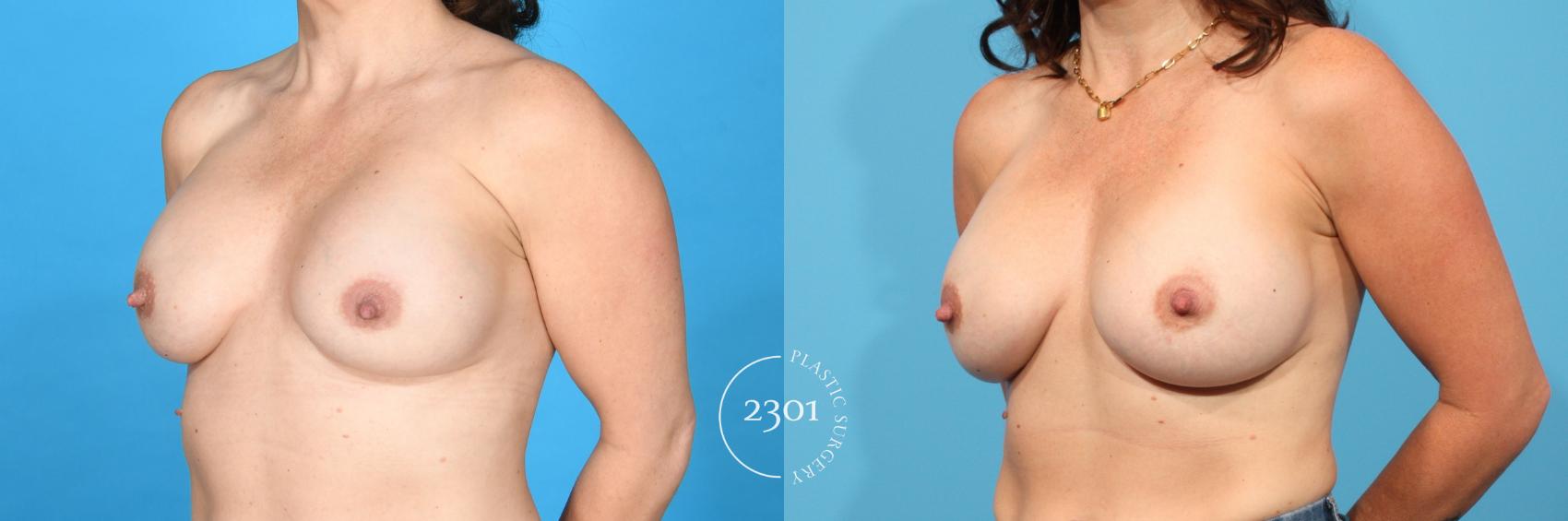 Before & After Breast Augmentation Revision Case 763 Left Oblique View in Fort Worth, Plano, & Frisco, Texas