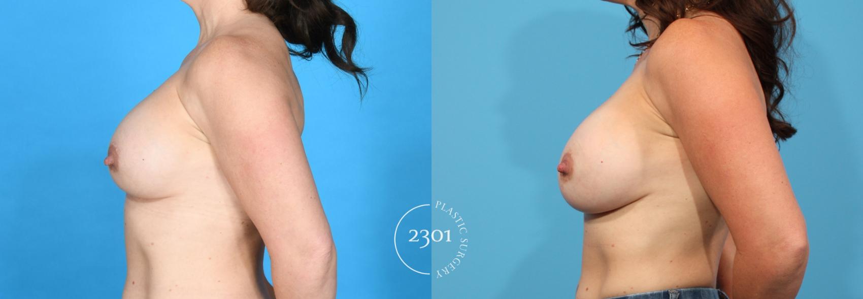 Before & After Breast Augmentation Revision Case 763 Left Side View in Fort Worth, Plano, & Frisco, Texas