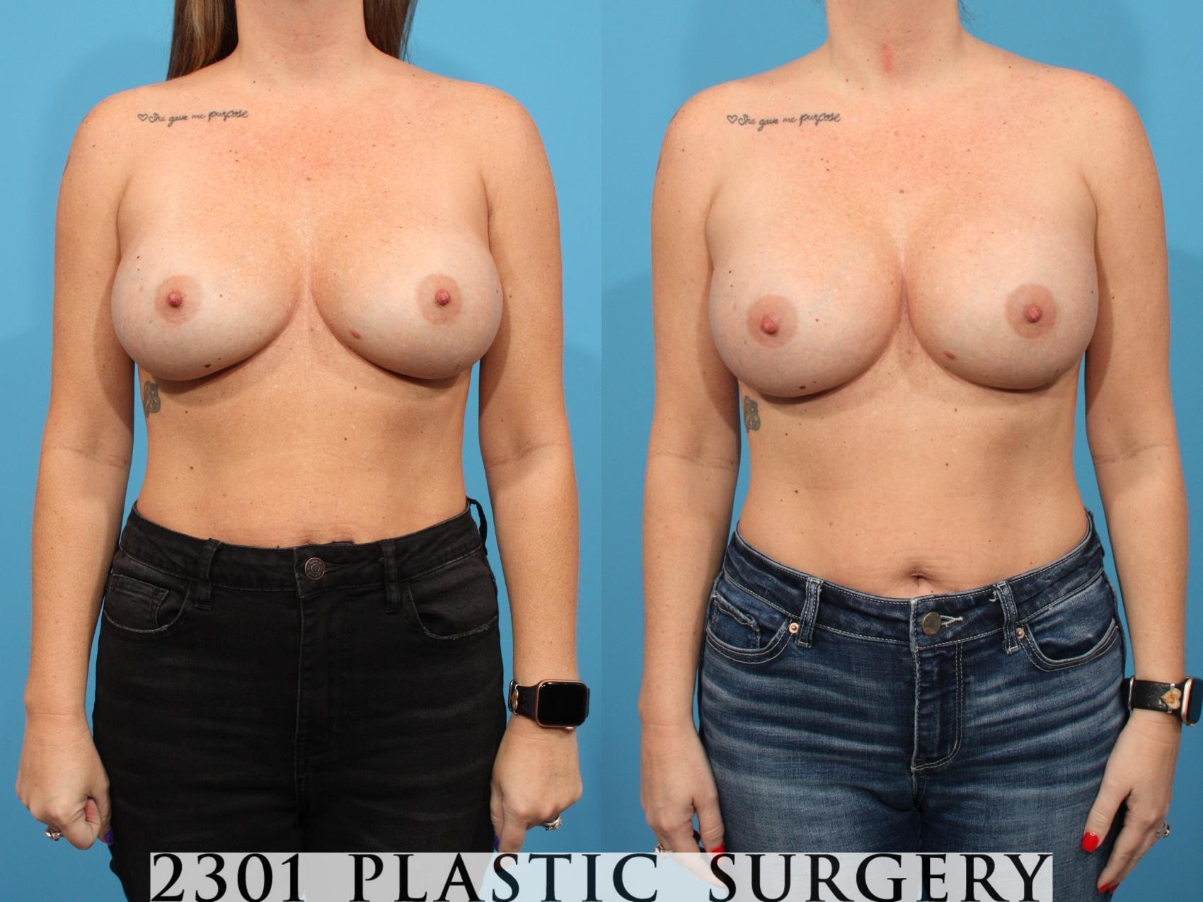 Before & After Breast Augmentation Revision Case 779 Front View in Fort Worth, Plano, & Frisco, Texas