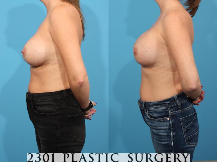 Before & After Breast Augmentation Revision Case 779 Left Side View in Fort Worth, Plano, & Frisco, Texas