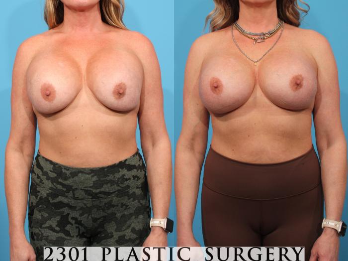 Before & After Breast Augmentation Revision Case 780 Front View in Fort Worth, Plano, & Frisco, Texas