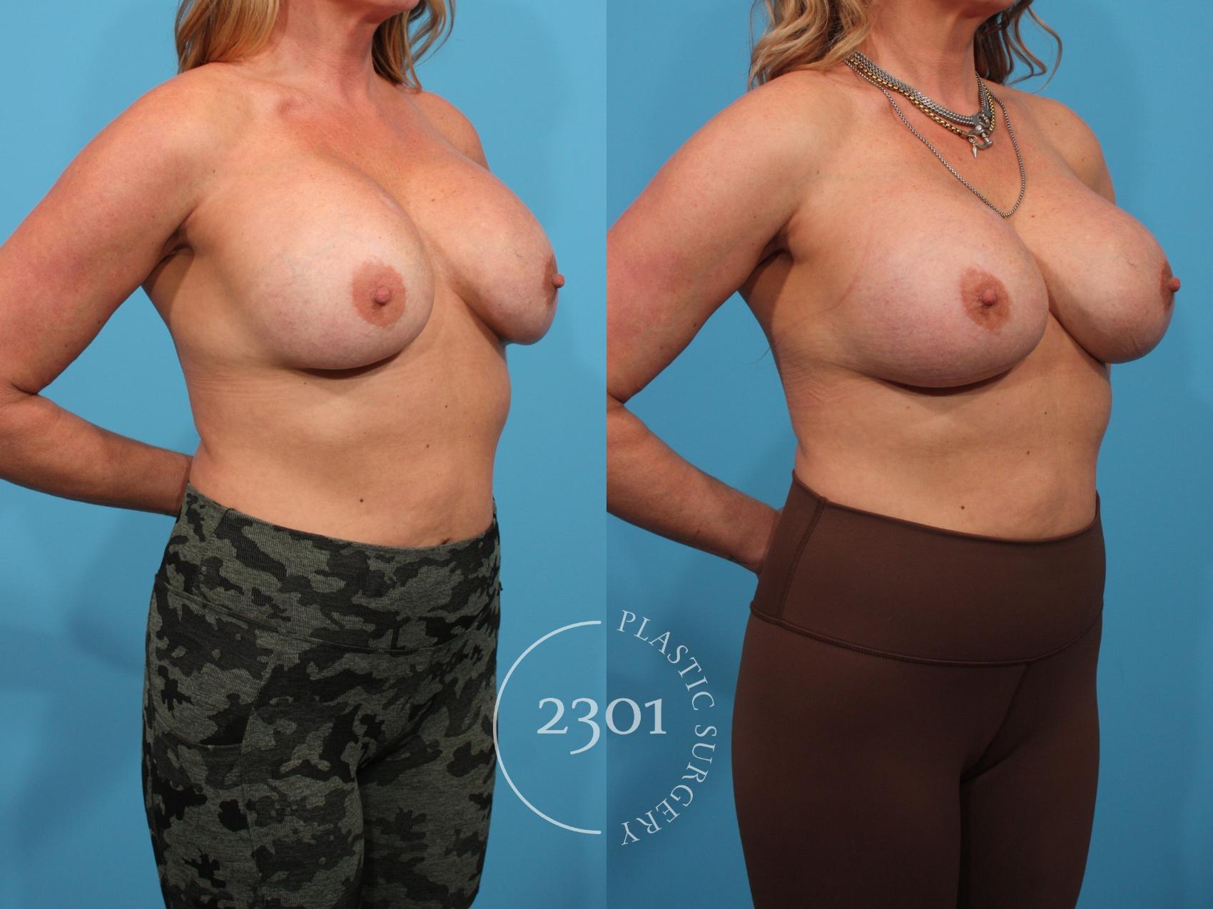 Before & After Breast Augmentation Revision Case 780 Right Oblique View in Fort Worth, Plano, & Frisco, Texas