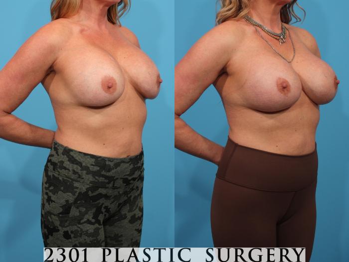Before & After Breast Augmentation Revision Case 780 Right Oblique View in Fort Worth, Plano, & Frisco, Texas