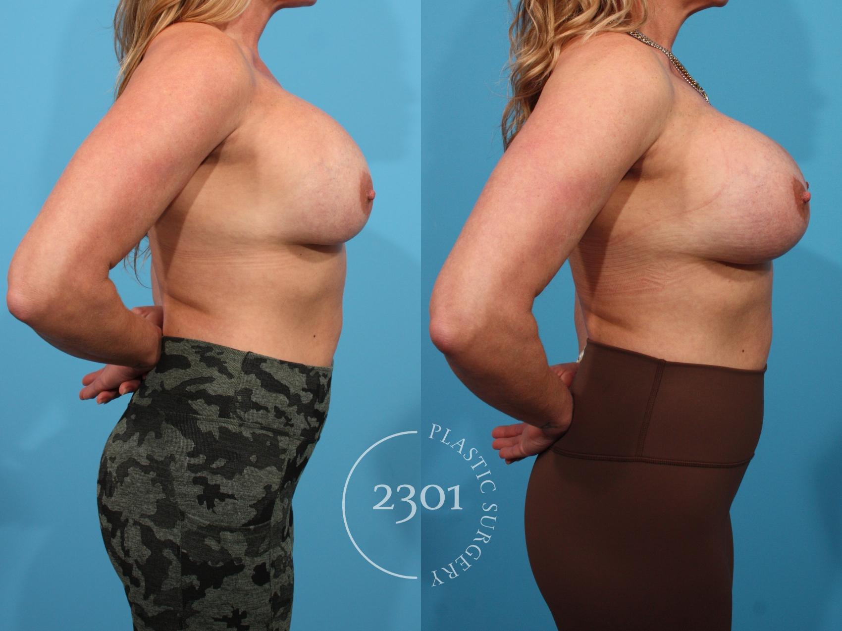 Before & After Breast Augmentation Revision Case 780 Right Side View in Fort Worth, Plano, & Frisco, Texas