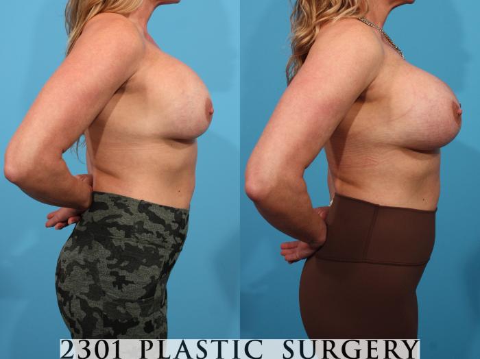 Before & After Breast Augmentation Revision Case 780 Right Side View in Fort Worth, Plano, & Frisco, Texas