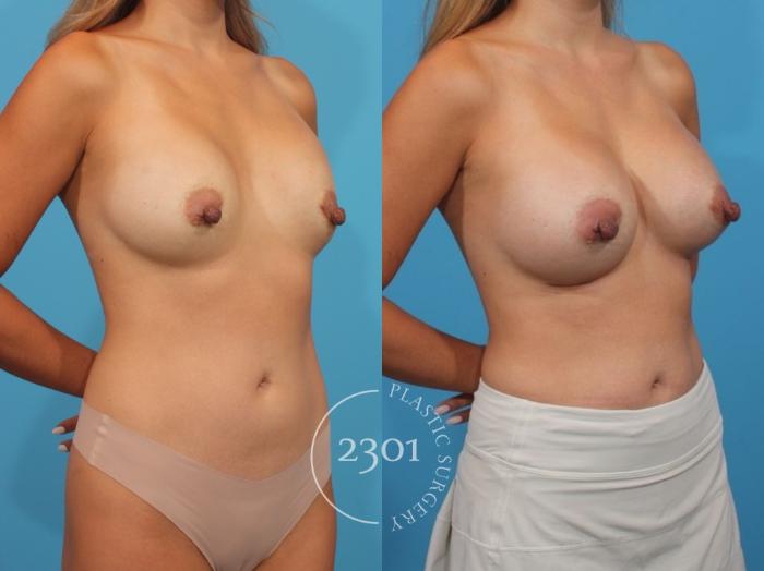 Before & After Breast Augmentation Case 830 Right Oblique View in Fort Worth, Plano, & Frisco, Texas