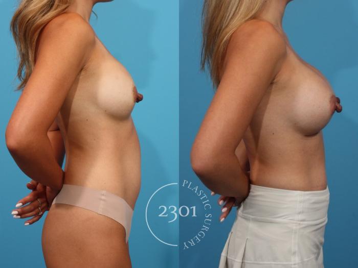 Before & After Breast Augmentation Case 830 Right Side View in Fort Worth, Plano, & Frisco, Texas