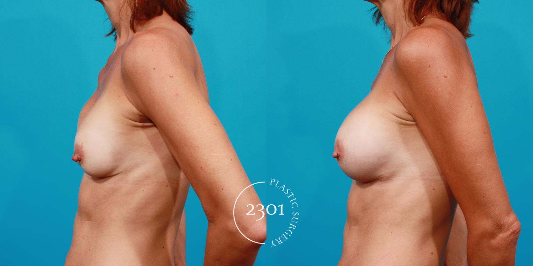 Before & After Breast Augmentation Revision Case 99 View #2 View in Fort Worth, Plano, & Frisco, Texas