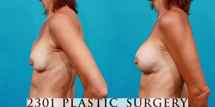 Before & After Silicone Implants Case 99 View #2 View in Fort Worth, Plano, & Frisco, Texas