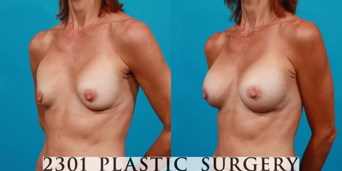 Before & After Silicone Implants Case 99 View #3 View in Fort Worth, Plano, & Frisco, Texas