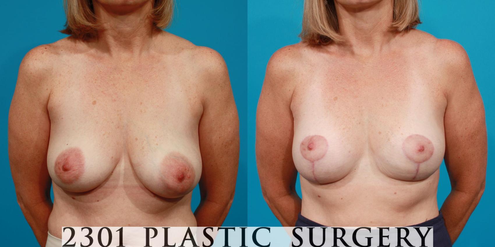 Before & After Breast Lift (Mastopexy) Case 102 View #1 View in Fort Worth, Plano, & Frisco, Texas