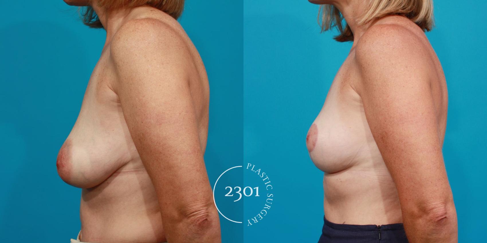 Before & After Breast Lift (Mastopexy) Case 102 View #2 View in Fort Worth, Plano, & Frisco, Texas