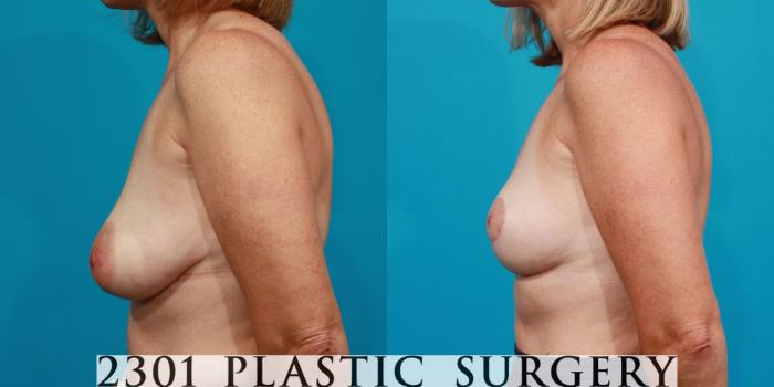 Before & After Breast Lift (Mastopexy) Case 102 View #2 View in Fort Worth, Plano, & Frisco, Texas
