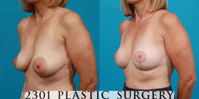 Before & After Breast Lift (Mastopexy) Case 102 View #3 View in Fort Worth, Plano, & Frisco, Texas