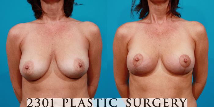 Before & After Breast Lift (Mastopexy) Case 129 View #1 View in Fort Worth, Plano, & Frisco, Texas