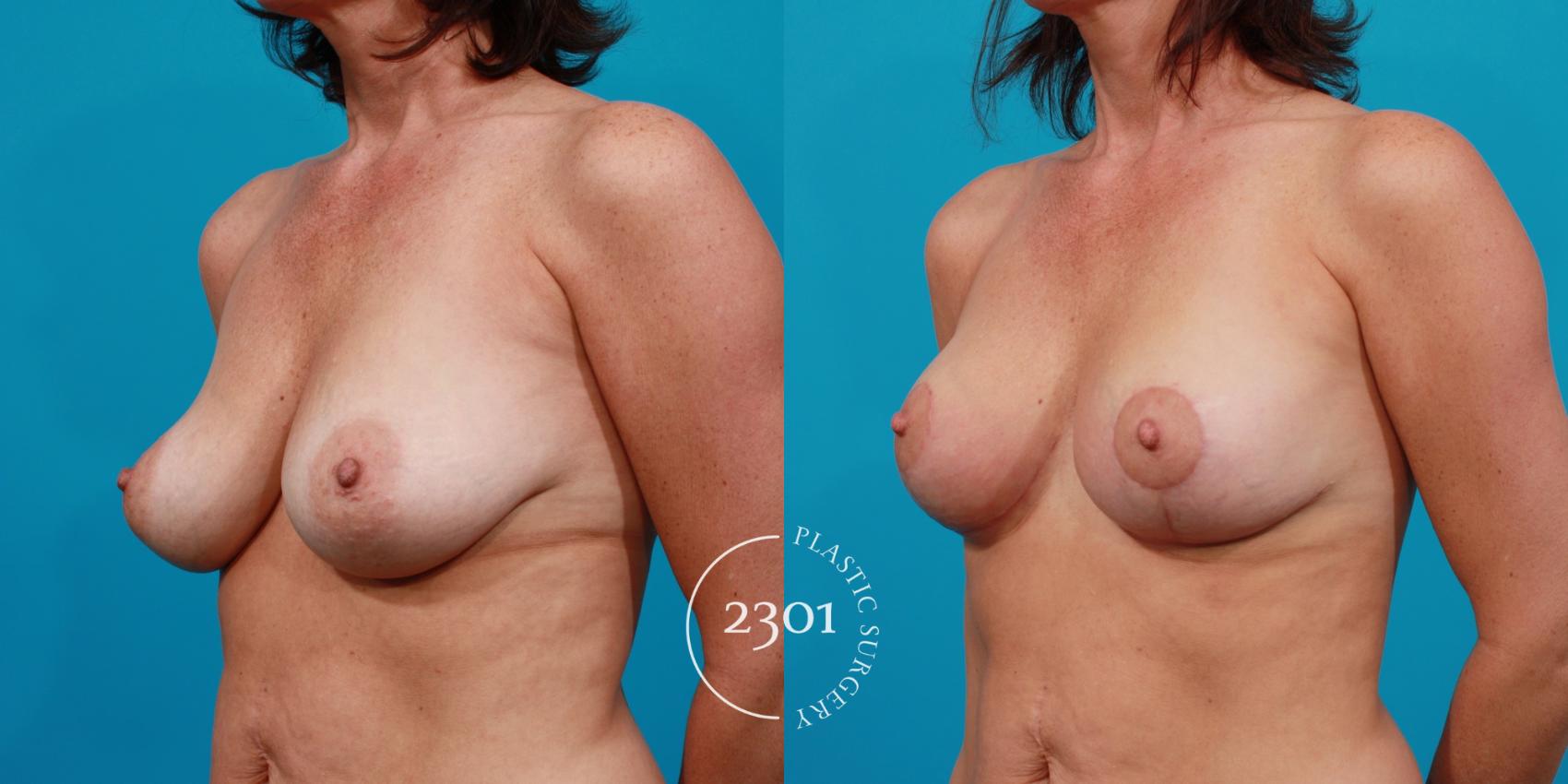 Before & After Breast Lift (Mastopexy) Case 129 View #3 View in Fort Worth, Plano, & Frisco, Texas