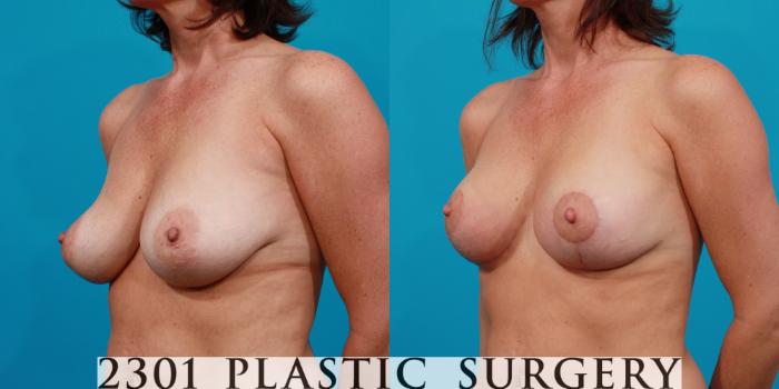 Before & After Breast Lift (Mastopexy) Case 129 View #3 View in Fort Worth, Plano, & Frisco, Texas
