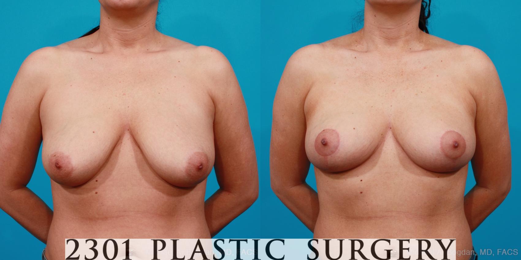 Before & After Breast Lift (Mastopexy) Case 156 View #1 View in Fort Worth, Plano, & Frisco, Texas