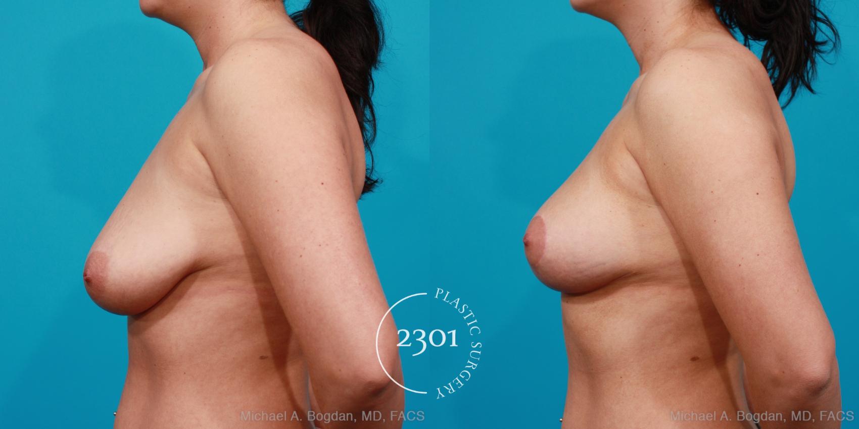 Before & After Breast Lift (Mastopexy) Case 156 View #2 View in Fort Worth, Plano, & Frisco, Texas