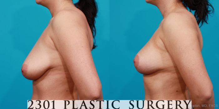 Before & After Breast Lift (Mastopexy) Case 156 View #2 View in Fort Worth, Plano, & Frisco, Texas