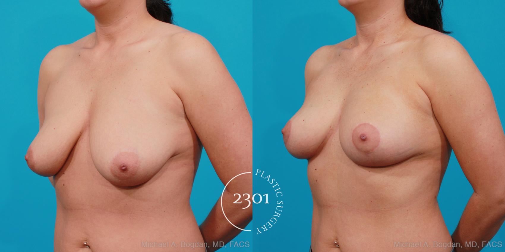 Before & After Breast Lift (Mastopexy) Case 156 View #3 View in Fort Worth, Plano, & Frisco, Texas