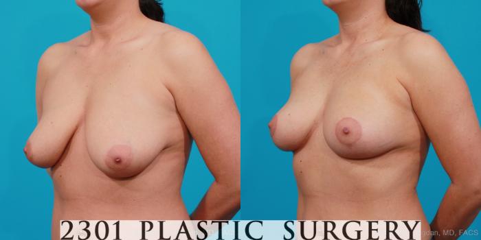 Before & After Breast Lift (Mastopexy) Case 156 View #3 View in Fort Worth, Plano, & Frisco, Texas