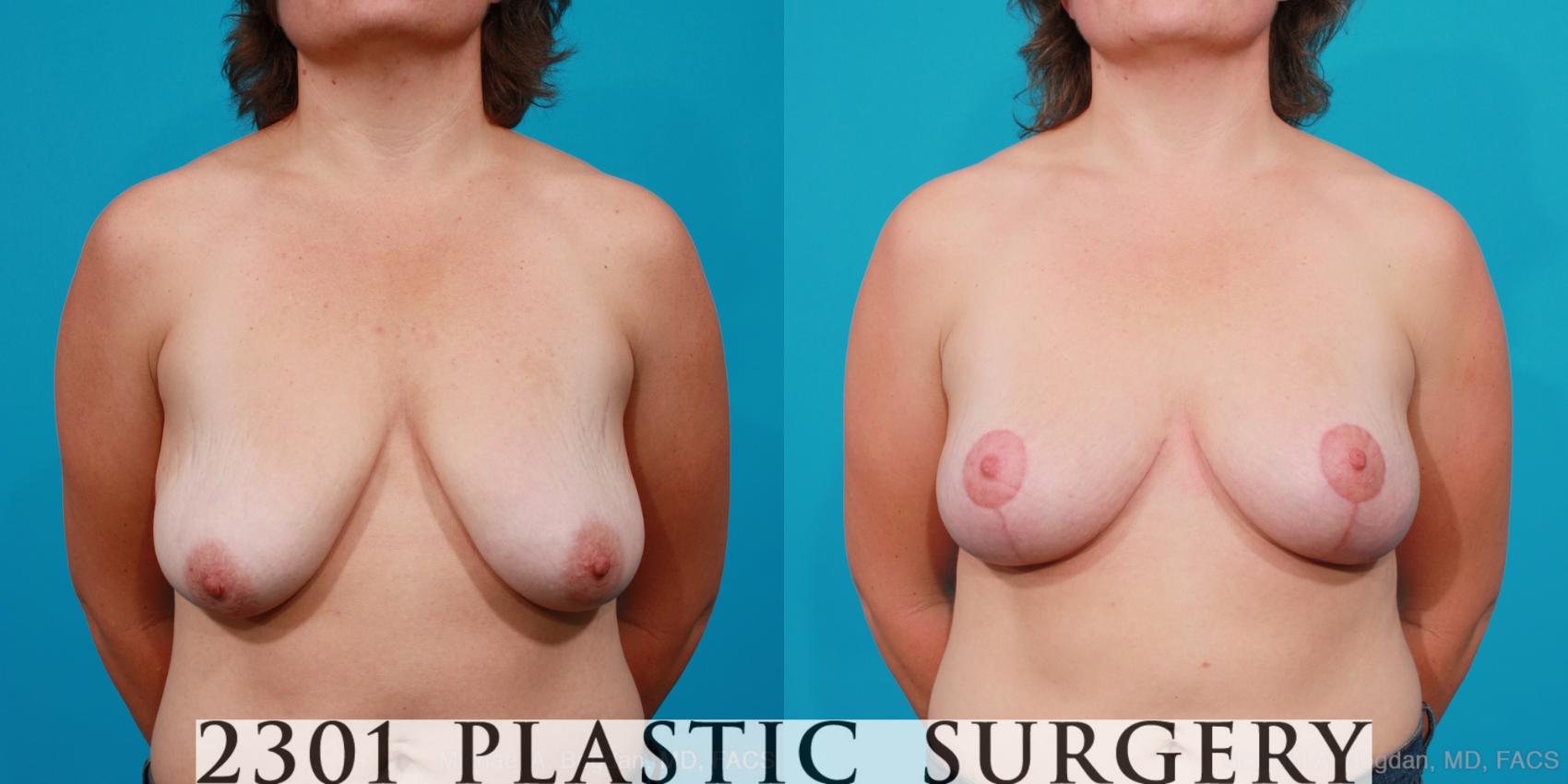 Before & After Breast Lift (Mastopexy) Case 167 View #1 View in Fort Worth, Plano, & Frisco, Texas